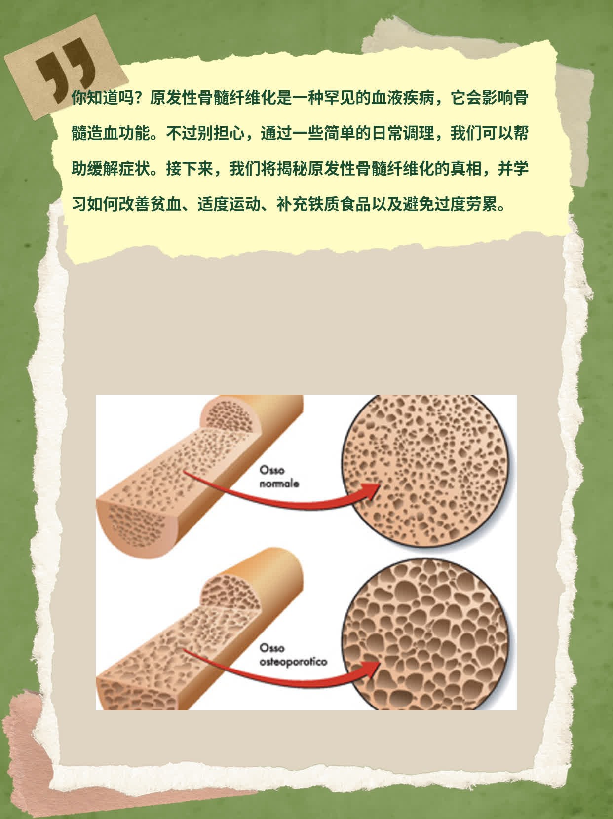 骨髓纤维化最新突破，开启疾病治疗新篇章